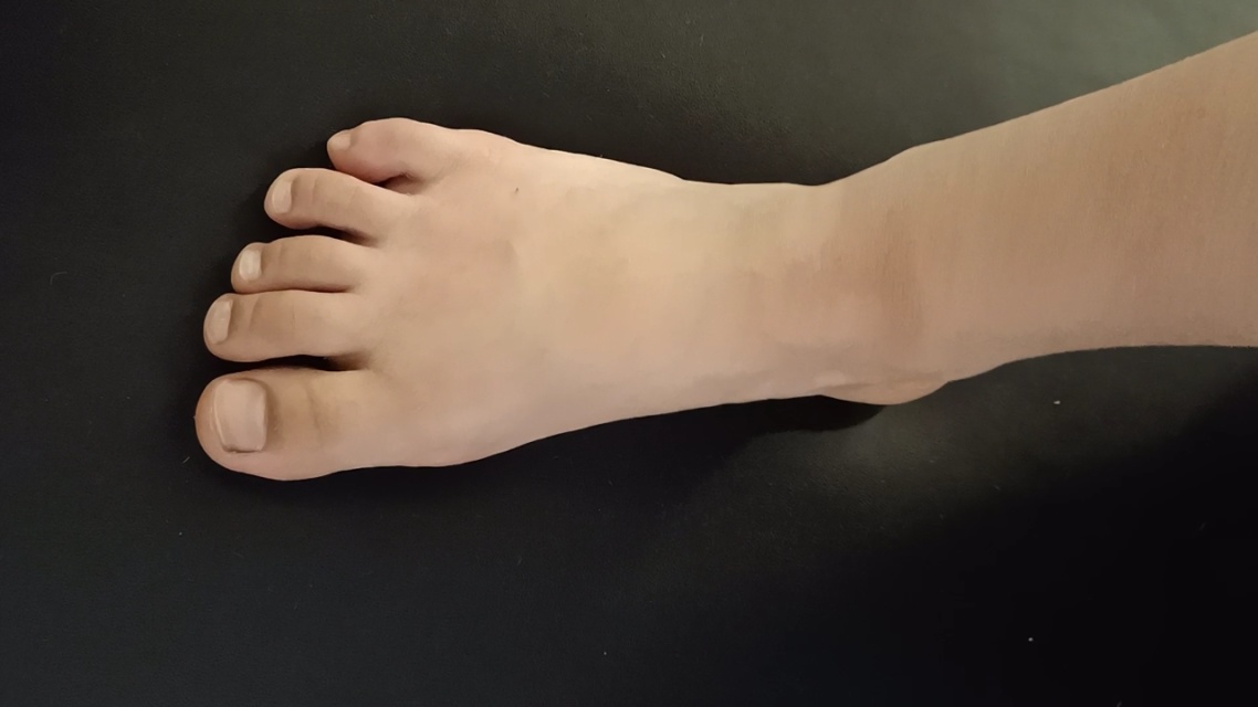 九岁女孩有跳舞一年的经历,第五趾骨和骰骨连接处出现外突出.