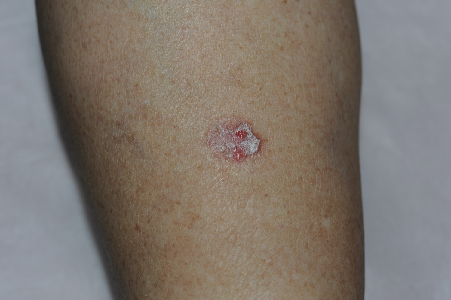 图4. 早期鳞状细胞癌---日光性角化症图5.