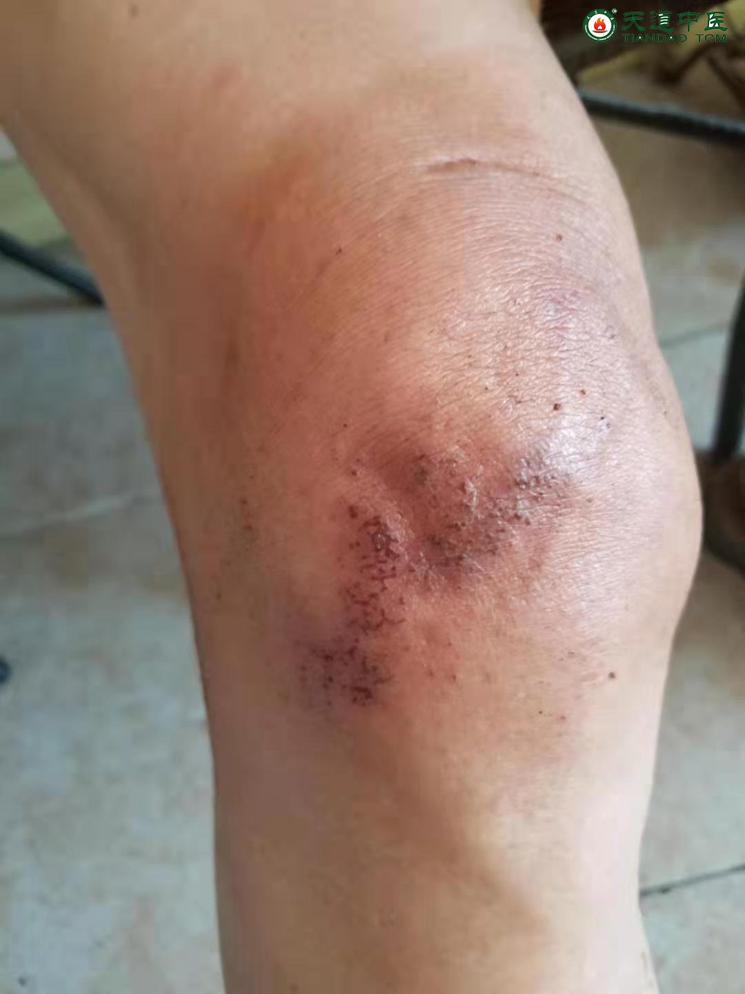 膝关节积液如何治疗