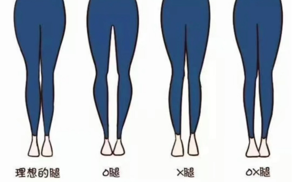 xo腿型纠正训练