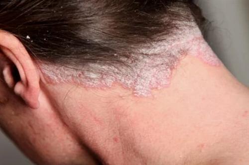 牛皮癣的初期图片