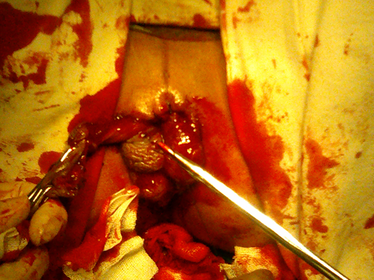 直肠脱垂图片 (60)_有来医生