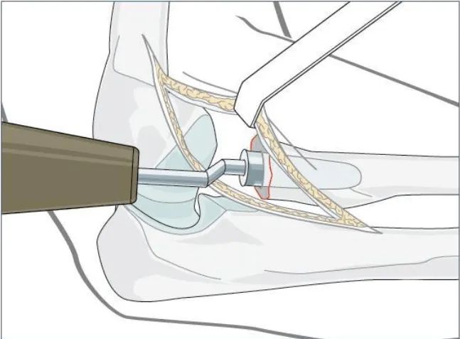 开封市第二中医院成功开展医院首例人工桡骨头置换术