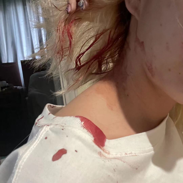 网红"小熊燕和"遭家暴,晒头部受伤流血图片,被邻居救后发文