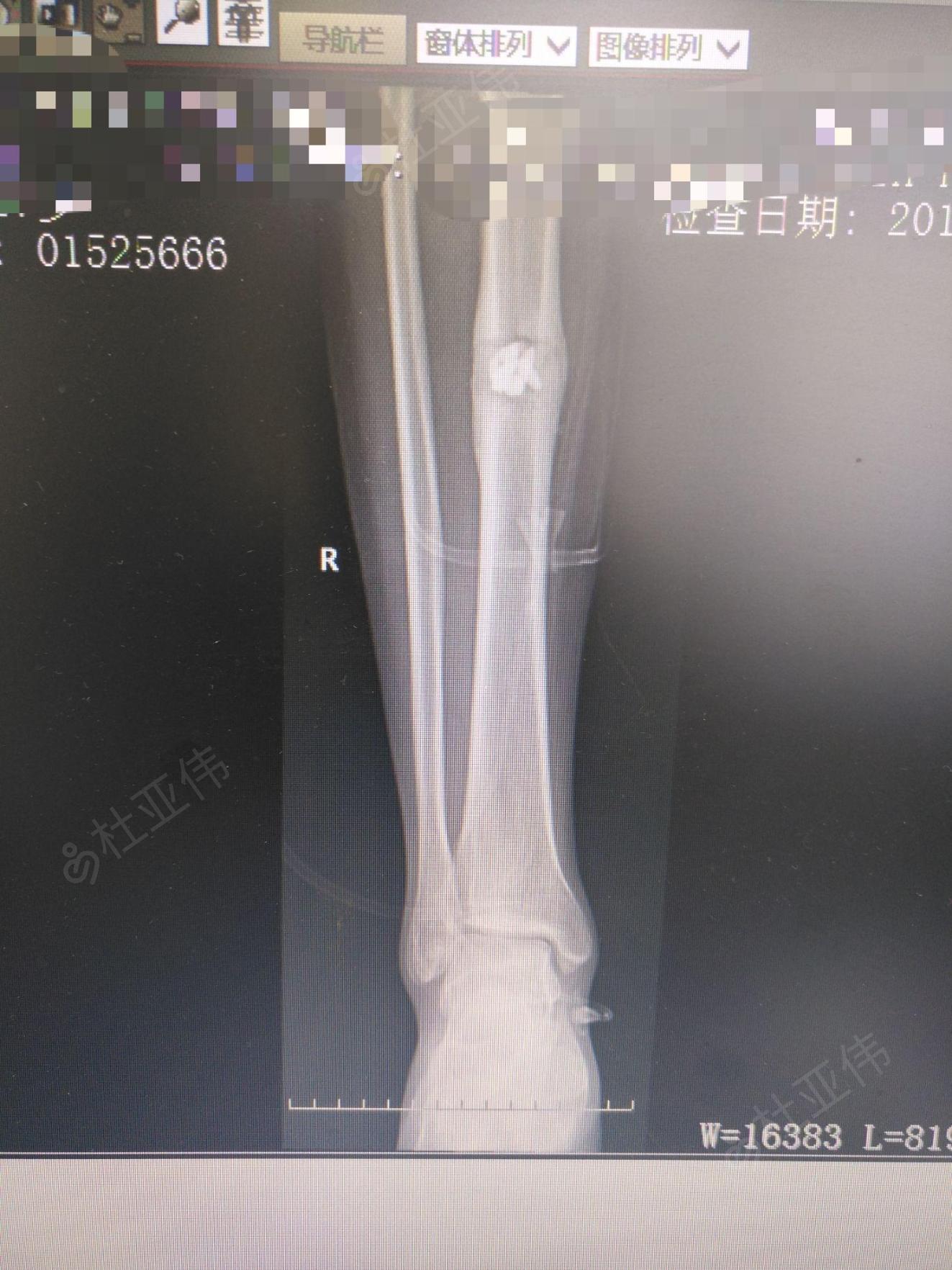 胫骨慢性骨髓炎