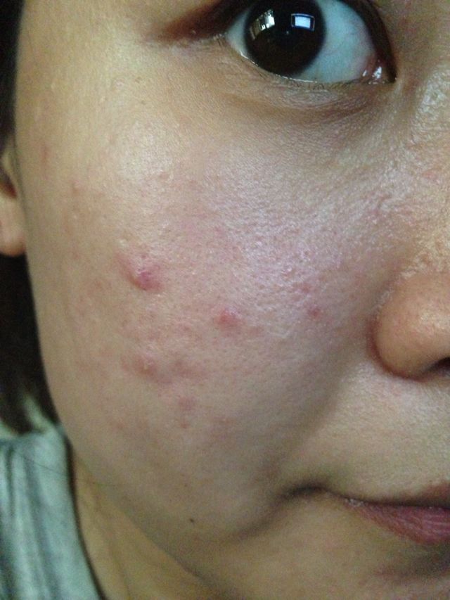 求救,痘痘肌肤~求帮助.