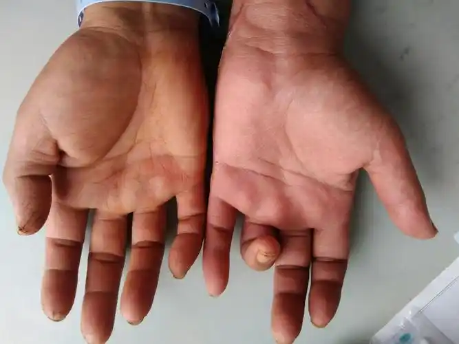 大鱼际肌萎缩明显