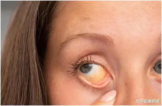 67肝病"劲敌"被发现,它才是"护肝之王",比菊花更清火养颜,每天吃点