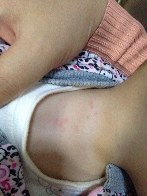 前天烧退了,昨天肚子上有,今天脖子上,这是幼儿急疹吗?