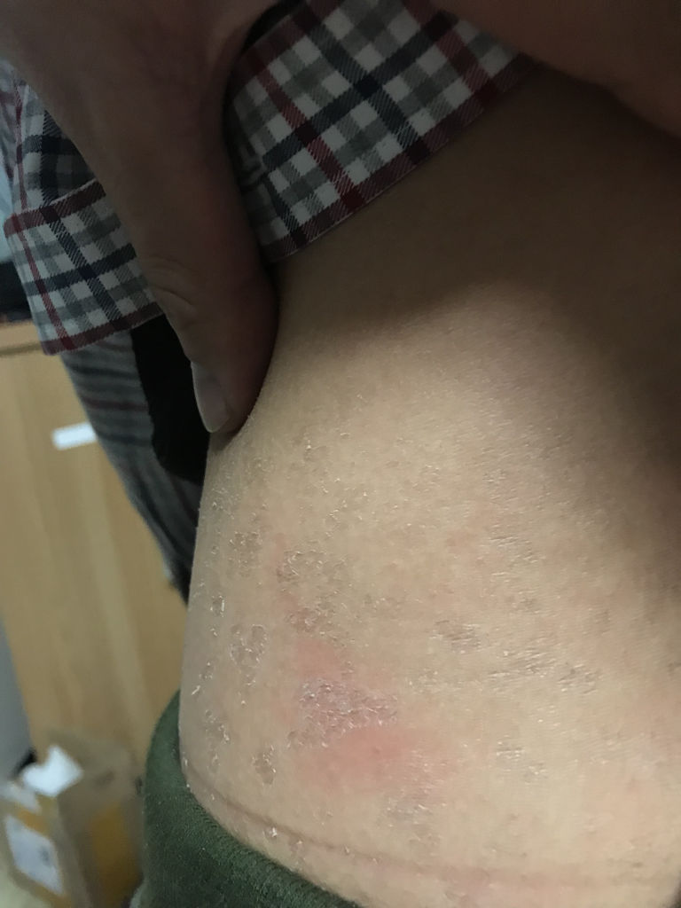 孩子的后背是这样子的皮肤,不疼不痒,面积还越来越大,这是什么情况?