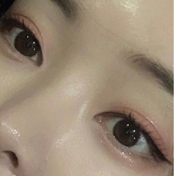 我做的是7.5毫米的平行双眼皮,杨蓉当时是给了我两_圈子-新氧美容整形