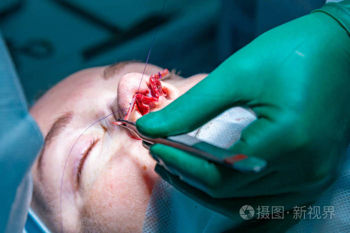 外科医生和他的助手执行整容手术在医院手术室的鼻子上.鼻整形, 隆胸.