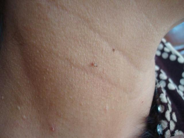 脖子,腋下的"小肉粒"是什么?会影响健康吗?建议引起重视