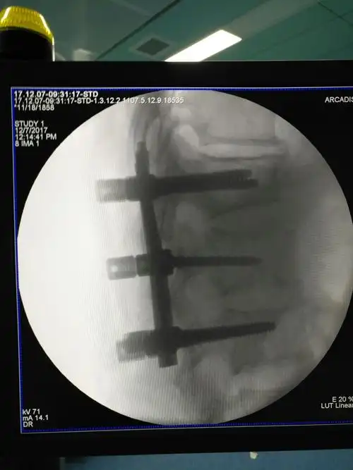 腰椎钉棒固定 减压术