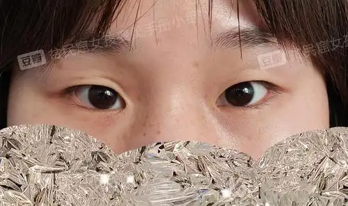 小眼睛肿眼皮眼睫毛都被眼皮压没了感觉整个人都没有精神怎么改善