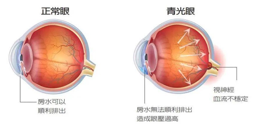 00度至3.00度为轻度近视,3.00度至6.00度为中度近视,6.