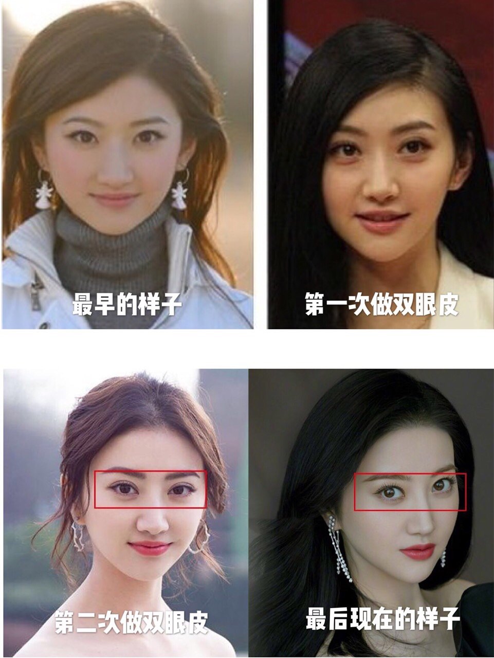 景甜的双眼皮曾经因为修复上了热搜,大家看了热搜里的_圈子-新氧美容