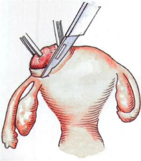 女人开腹结扎输卵管