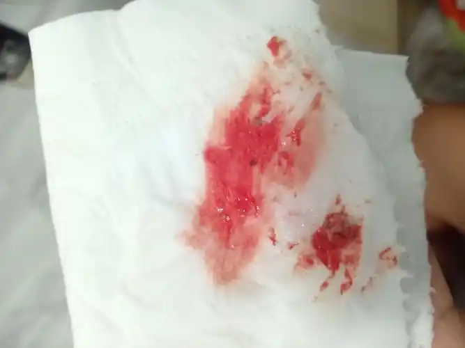 [试管婴儿]移植二十一天!出血!有相同的姐