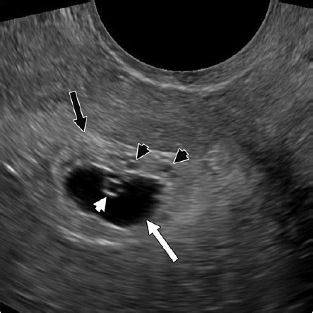 圆形的孕囊长什么样