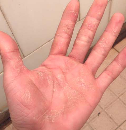 手皲裂性湿疹怎么治疗选对产品才能快速祛湿疹