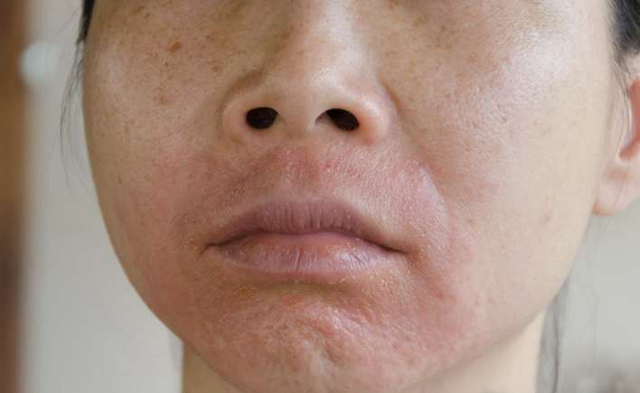 保护皮肤的屏障功能破坏,皮肤到处开裂,缝隙之间进入了刺激性物质