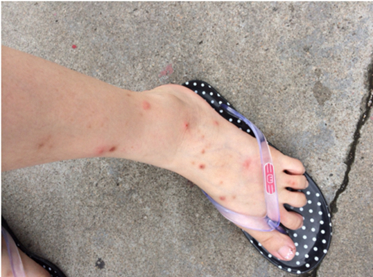 虫咬性皮炎图片 (132)