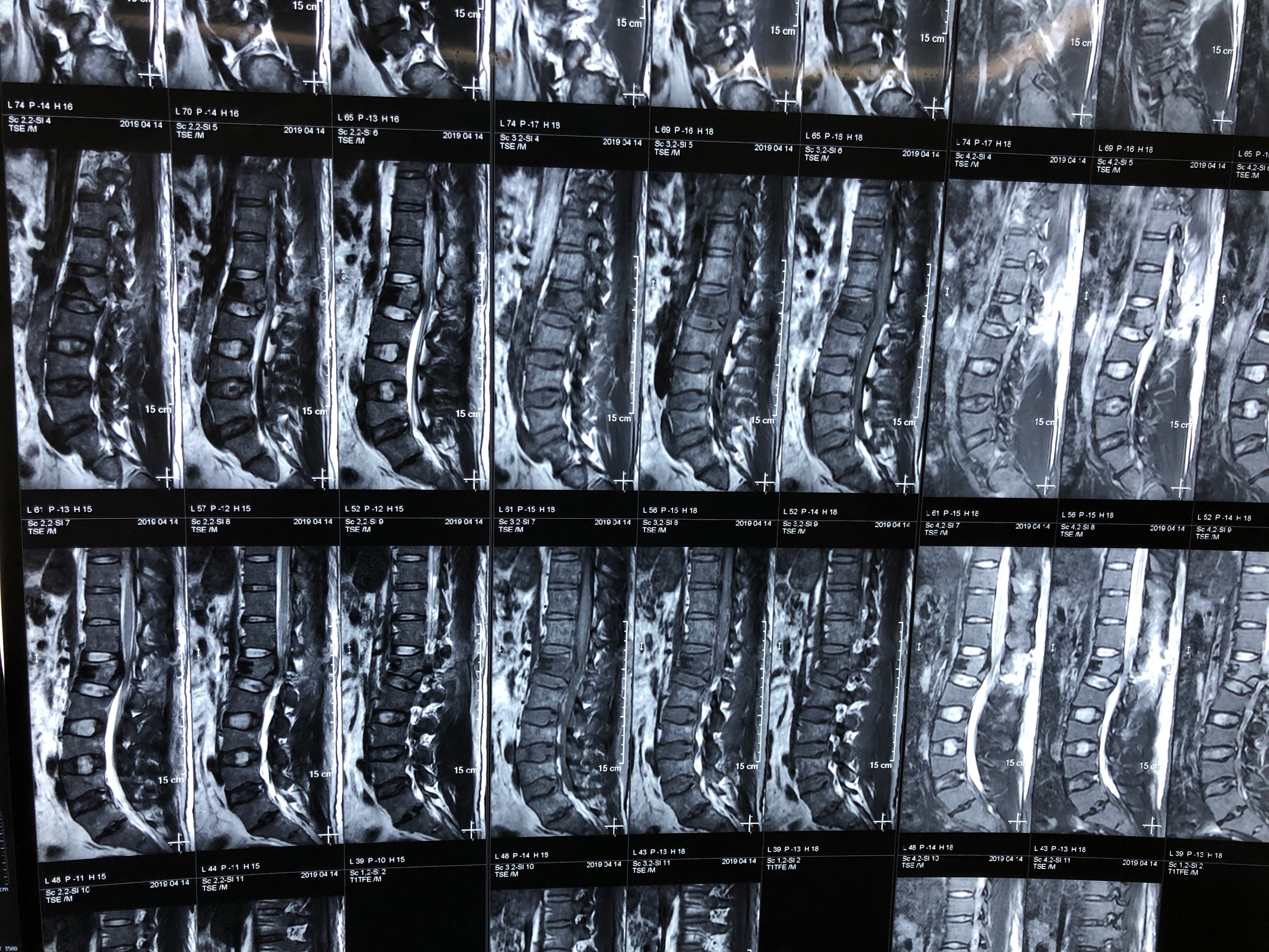 年轻患者腰椎压缩性骨折,钉棒固定,减压复位 - 好大夫在线