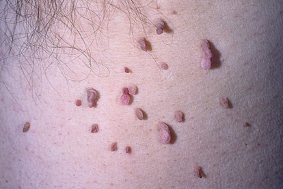 腋下丝状疣图片