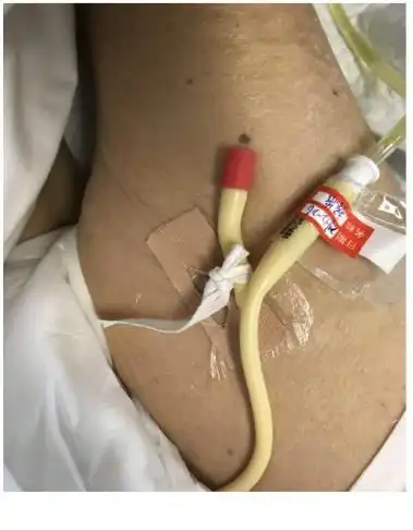 尿管固定在大腿上1/3处,防止牵拉后损伤尿道,防止尿管脱出.