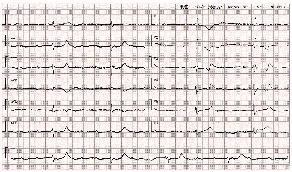 心电图库丨三度房室传导阻滞系列_心律_窦性_患者