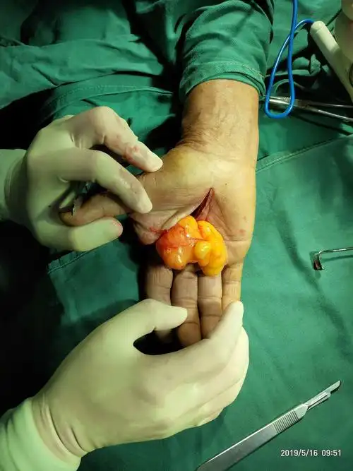 手部巨大脂肪瘤一例!(副本)