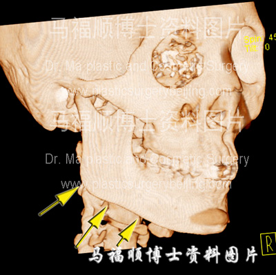 下颌骨雕刻瘦脸整形术