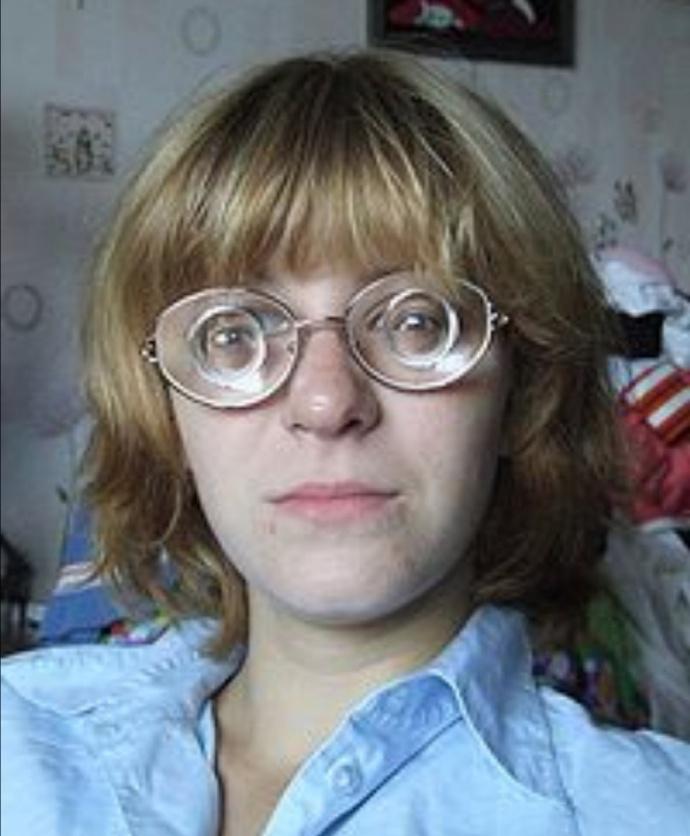 注意高度近视会导致的很多病发症度数600多的人必看