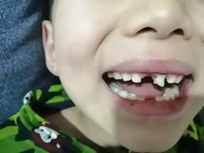 【成长记19】掉牙了