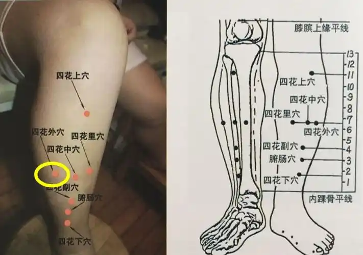 董氏奇穴丨刺血疗法