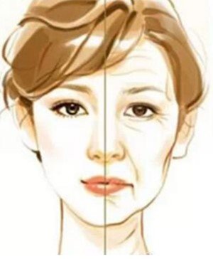 面部衰老,皮肤松弛的人,做自体脂肪填充效果好不好?