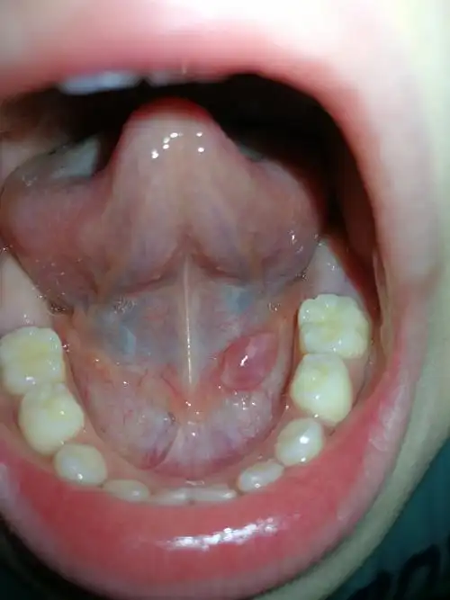 儿子舌头底下有个小肉芽,早就有,但是最近几天长大了,长的挺快