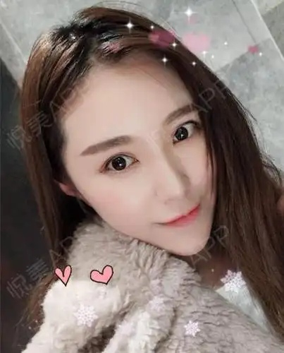 做双眼皮之前我的眼睛不是很小,就是眼皮下垂,赘皮多.