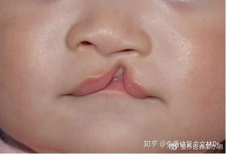 兔唇在几个月可以查出