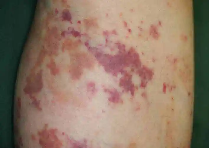 什么是紫癜轻微紫癜的症状图片