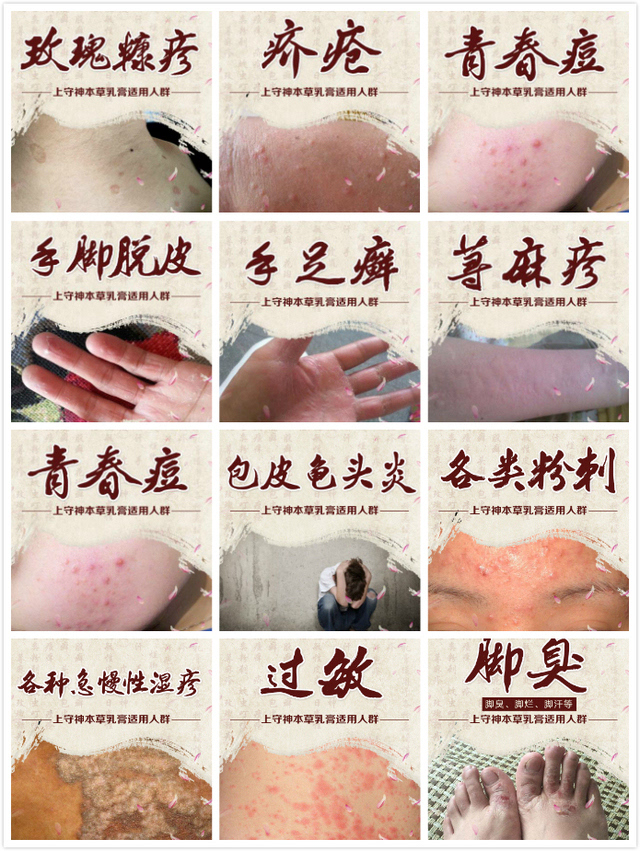 晨隽堂,上守神〗本草乳膏适用于 各种急慢性湿疹(阴囊湿疹,肛门湿疹