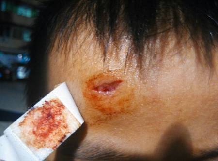 问:小孩子头破了 这样子用不用连线?