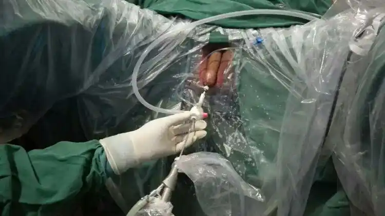 3cm,智能监控内压输尿管硬镜碎石鞘吸引取石术,手术时间83分钟,手术