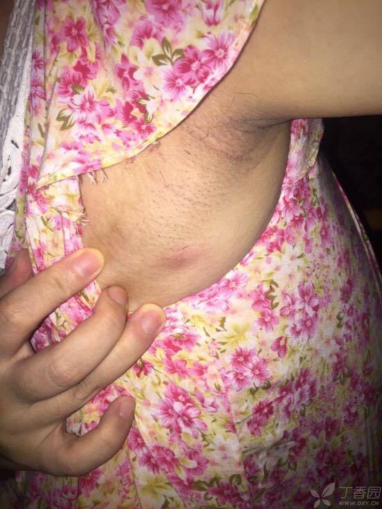 患者女,28岁,腋下有一颗黄豆大小硬块,手按它有点痛,平时不痛,这个是