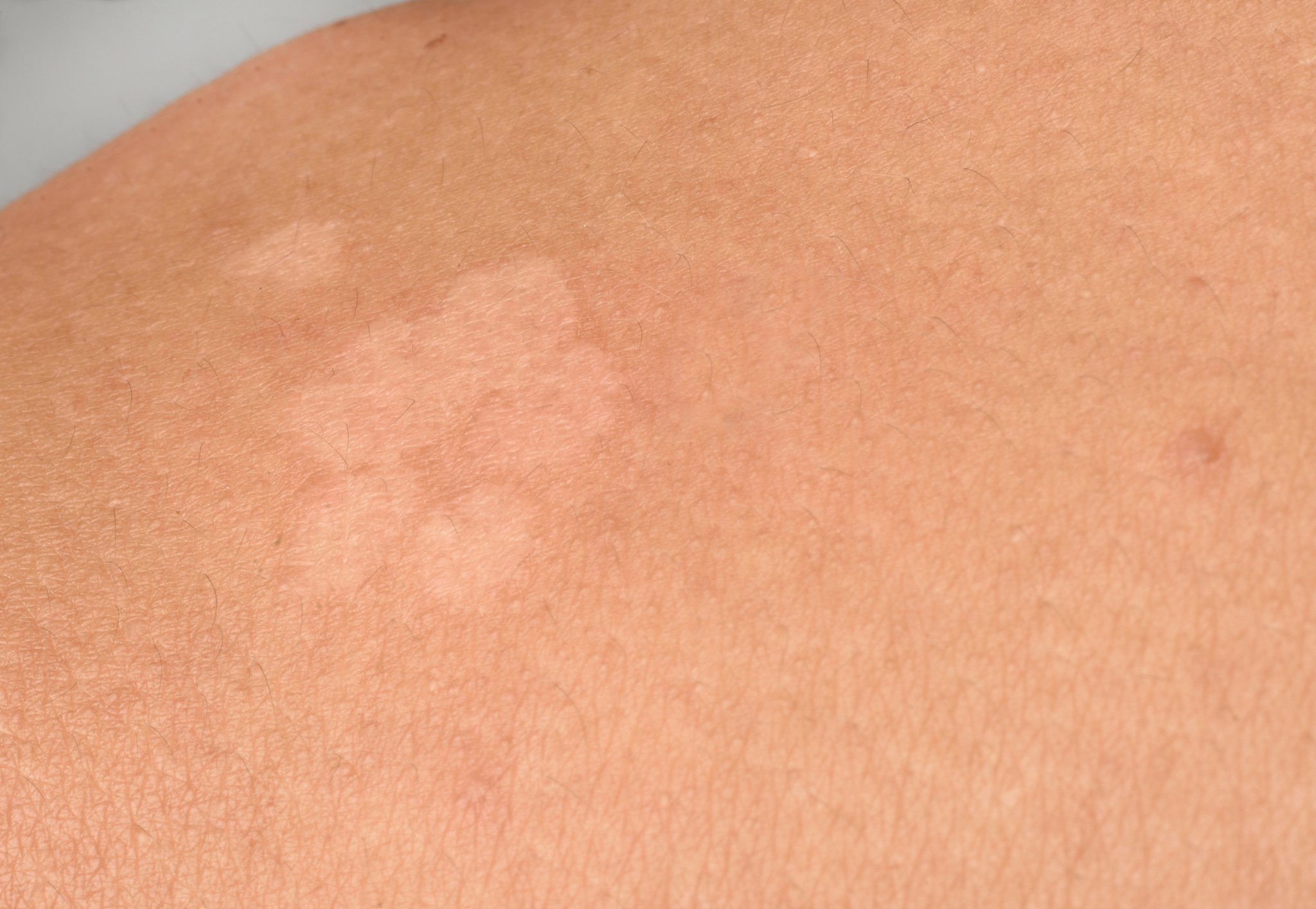 阴茎上长了白斑怎么办	阴茎上长了白斑要根据出现的原因进行针对性