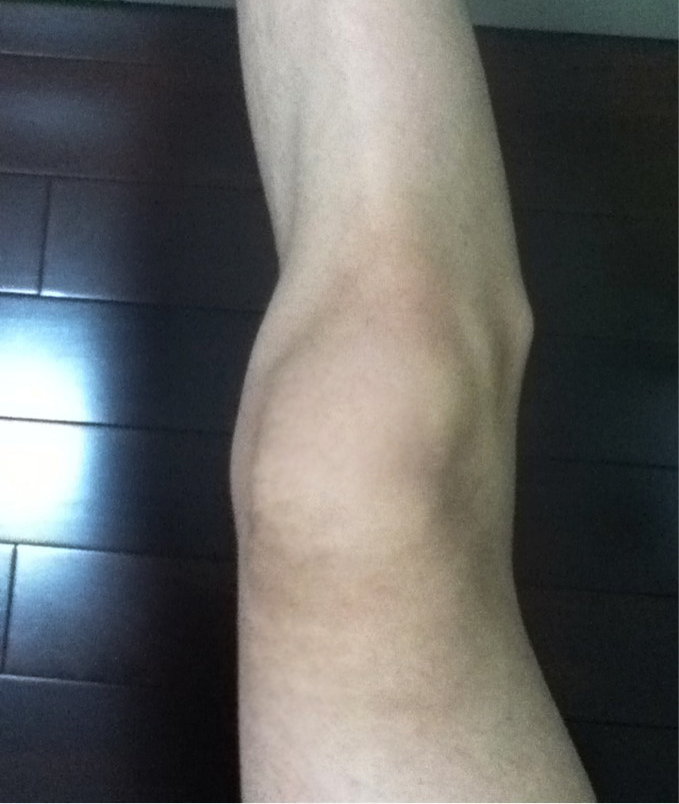 膝盖外侧骨头突出图片