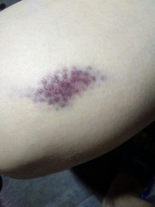 老婆怀孕7个月不小心撞到木门,腿部出现淤青怎么处理?