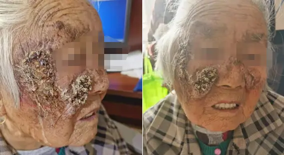 病例夹老年斑竟然长成了皮肤癌