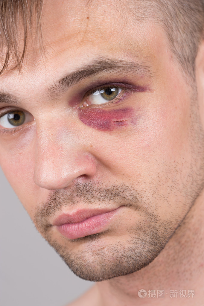 受伤的眼睛的人.特写照片-正版商用图片1ji8lm-摄图新视界